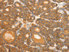 The image on the left is immunohistochemistry of paraffin-embedded Human thyroid cancer tissue using CSB-PA797544 (SCT Antibody) at dilution 1/40, on the right is treated with synthetic peptide. (Original magnification: ×200)
