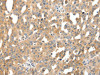 The image on the left is immunohistochemistry of paraffin-embedded Human liver cancer tissue using CSB-PA336738 (SCTR Antibody) at dilution 1/25, on the right is treated with synthetic peptide. (Original magnification: ×200)