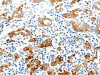 The image on the left is immunohistochemistry of paraffin-embedded Human gastic cancer tissue using CSB-PA969377 (SEL1L Antibody) at dilution 1/25, on the right is treated with synthetic peptide. (Original magnification: ×200) The image on the left is immunohistochemistry of paraffin-embedded Human gastic cancer tissue using CSB-PA969377 (SEL1L Antibody) at dilution 1/25, on the right is treated with synthetic peptide. (Original magnification: ×200)