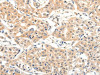The image on the left is immunohistochemistry of paraffin-embedded Human lung cancer tissue using CSB-PA232605 (SLC27A1 Antibody) at dilution 1/40, on the right is treated with synthetic peptide. (Original magnification: ×200)
