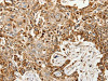The image on the left is immunohistochemistry of paraffin-embedded Human esophagus cancer tissue using CSB-PA261251 (SLC9A7 Antibody) at dilution 1/60, on the right is treated with synthetic peptide. (Original magnification: ×200)