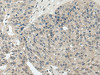 The image on the left is immunohistochemistry of paraffin-embedded Human breast cancer tissue using CSB-PA800154 (STRA6 Antibody) at dilution 1/20, on the right is treated with synthetic peptide. (Original magnification: ×200)