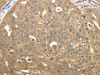 The image on the left is immunohistochemistry of paraffin-embedded Human ovarian cancer tissue using CSB-PA922926 (STX1A Antibody) at dilution 1/40, on the right is treated with synthetic peptide. (Original magnification: ×200)