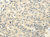 The image on the left is immunohistochemistry of paraffin-embedded Human breast cancer tissue using CSB-PA981570 (GAD1 Antibody) at dilution 1/20, on the right is treated with synthetic peptide. (Original magnification: ×200)