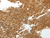 The image on the left is immunohistochemistry of paraffin-embedded Human liver cancer tissue using CSB-PA976408 (TNXB Antibody) at dilution 1/40, on the right is treated with synthetic peptide. (Original magnification: ×200)