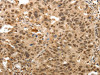 The image on the left is immunohistochemistry of paraffin-embedded Human lung cancer tissue using CSB-PA290377 (TNXB Antibody) at dilution 1/30, on the right is treated with synthetic peptide. (Original magnification: ×200)
