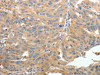 The image on the left is immunohistochemistry of paraffin-embedded Human ovarian cancer tissue using CSB-PA585649 (TERT Antibody) at dilution 1/50, on the right is treated with synthetic peptide. (Original magnification: ×200)