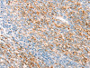 The image on the left is immunohistochemistry of paraffin-embedded Human ovarian cancer tissue using CSB-PA058340 (THY1 Antibody) at dilution 1/25, on the right is treated with synthetic peptide. (Original magnification: ×200)