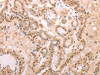 The image on the left is immunohistochemistry of paraffin-embedded Human thyroid cancer tissue using CSB-PA721303 (PTMA Antibody) at dilution 1/25, on the right is treated with synthetic peptide. (Original magnification: ×200)
