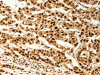 The image on the left is immunohistochemistry of paraffin-embedded Human cervical cancer tissue using CSB-PA162542 (TIGAR Antibody) at dilution 1/80, on the right is treated with synthetic peptide. (Original magnification: ×200)