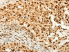 The image on the left is immunohistochemistry of paraffin-embedded Human breast cancer tissue using CSB-PA162542 (TIGAR Antibody) at dilution 1/80, on the right is treated with synthetic peptide. (Original magnification: ×200)