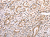 The image on the left is immunohistochemistry of paraffin-embedded Human gastric cancer tissue using CSB-PA973727 (TXN Antibody) at dilution 1/30, on the right is treated with synthetic peptide. (Original magnification: ×200)