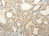The image on the left is immunohistochemistry of paraffin-embedded Human thyroid cancer tissue using CSB-PA983024 (FAT3 Antibody) at dilution 1/20, on the right is treated with synthetic peptide. (Original magnification: ×200) The image on the left is immunohistochemistry of paraffin-embedded Human thyroid cancer tissue using CSB-PA983024 (FAT3 Antibody) at dilution 1/20, on the right is treated with synthetic peptide. (Original magnification: ×200)