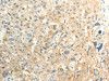 The image on the left is immunohistochemistry of paraffin-embedded Human esophagus cancer tissue using CSB-PA068600 (FAT3 Antibody) at dilution 1/30, on the right is treated with synthetic peptide. (Original magnification: ×200)