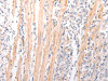 The image on the left is immunohistochemistry of paraffin-embedded Human gastric cancer tissue using CSB-PA949432 (ABCA2 Antibody) at dilution 1/25, on the right is treated with synthetic peptide. (Original magnification: ×200)