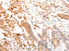 The image on the left is immunohistochemistry of paraffin-embedded Human colon cancer tissue using CSB-PA217707 (ABCA4 Antibody) at dilution 1/30, on the right is treated with synthetic peptide. (Original magnification: ×200)
