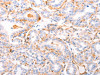 The image on the left is immunohistochemistry of paraffin-embedded Human thyroid cancer tissue using CSB-PA217707 (ABCA4 Antibody) at dilution 1/30, on the right is treated with synthetic peptide. (Original magnification: ×200)
