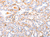 The image on the left is immunohistochemistry of paraffin-embedded Human thyroid cancer tissue using CSB-PA217707 (ABCA4 Antibody) at dilution 1/30, on the right is treated with synthetic peptide. (Original magnification: ×200)