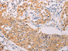 The image on the left is immunohistochemistry of paraffin-embedded Human lung cancer tissue using CSB-PA787644 (ADHFE1 Antibody) at dilution 1/30, on the right is treated with synthetic peptide. (Original magnification: ×200)