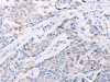 The image on the left is immunohistochemistry of paraffin-embedded Human breast cancer tissue using CSB-PA090961 (AKT2 Antibody) at dilution 1/70, on the right is treated with synthetic peptide. (Original magnification: ×200)
