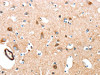 The image on the left is immunohistochemistry of paraffin-embedded Human brain tissue using CSB-PA066208 (AARS Antibody) at dilution 1/50, on the right is treated with synthetic peptide. (Original magnification: ×200)