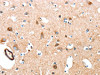 The image on the left is immunohistochemistry of paraffin-embedded Human brain tissue using CSB-PA066208 (AARS Antibody) at dilution 1/50, on the right is treated with synthetic peptide. (Original magnification: ×200)