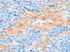 The image on the left is immunohistochemistry of paraffin-embedded Human esophagus cancer tissue using CSB-PA066208 (AARS Antibody) at dilution 1/50, on the right is treated with synthetic peptide. (Original magnification: ×200)