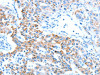 The image on the left is immunohistochemistry of paraffin-embedded Human lung cancer tissue using CSB-PA273719 (ALDH5A1 Antibody) at dilution 1/60, on the right is treated with synthetic peptide. (Original magnification: ×200)