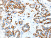 The image on the left is immunohistochemistry of paraffin-embedded Human thyroid cancer tissue using CSB-PA553471 (ALDH5A1 Antibody) at dilution 1/35, on the right is treated with synthetic peptide. (Original magnification: ×200)