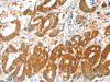 The image on the left is immunohistochemistry of paraffin-embedded Human colon cancer tissue using CSB-PA553471 (ALDH5A1 Antibody) at dilution 1/35, on the right is treated with synthetic peptide. (Original magnification: ×200)