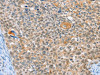 The image on the left is immunohistochemistry of paraffin-embedded Human cervical cancer tissue using CSB-PA969647 (ALDOB Antibody) at dilution 1/40, on the right is treated with synthetic peptide. (Original magnification: ×200)