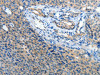 The image on the left is immunohistochemistry of paraffin-embedded Human cervical cancer tissue using CSB-PA695367 (ATP1A1 Antibody) at dilution 1/35, on the right is treated with synthetic peptide. (Original magnification: ×200)