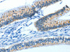 The image on the left is immunohistochemistry of paraffin-embedded Human colon cancer tissue using CSB-PA695367 (ATP1A1 Antibody) at dilution 1/35, on the right is treated with synthetic peptide. (Original magnification: ×200)