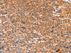 The image on the left is immunohistochemistry of paraffin-embedded Human liver cancer tissue using CSB-PA920990 (AMPD1 Antibody) at dilution 1/80, on the right is treated with synthetic peptide. (Original magnification: ×200) The image on the left is immunohistochemistry of paraffin-embedded Human liver cancer tissue using CSB-PA920990 (AMPD1 Antibody) at dilution 1/80, on the right is treated with synthetic peptide. (Original magnification: ×200)