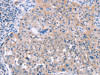 The image on the left is immunohistochemistry of paraffin-embedded Human lung cancer tissue using CSB-PA062845 (AP1B1 Antibody) at dilution 1/70, on the right is treated with synthetic peptide. (Original magnification: ×200)