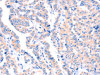The image on the left is immunohistochemistry of paraffin-embedded Human thyroid cancer tissue using CSB-PA504012 (APBA2 Antibody) at dilution 1/80, on the right is treated with synthetic peptide. (Original magnification: ×200)