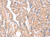 The image on the left is immunohistochemistry of paraffin-embedded Human thyroid cancer tissue using CSB-PA782005 (APBA2 Antibody) at dilution 1/80, on the right is treated with synthetic peptide. (Original magnification: ×200)