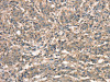 The image on the left is immunohistochemistry of paraffin-embedded Human gastric cancer tissue using CSB-PA010692 (APC Antibody) at dilution 1/25, on the right is treated with synthetic peptide. (Original magnification: ×200)