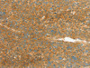 The image on the left is immunohistochemistry of paraffin-embedded Human liver cancer tissue using CSB-PA832036 (APOL2 Antibody) at dilution 1/80, on the right is treated with synthetic peptide. (Original magnification: ×200)