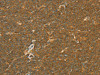 The image on the left is immunohistochemistry of paraffin-embedded Human lymphoma tissue using CSB-PA832036 (APOL2 Antibody) at dilution 1/80, on the right is treated with synthetic peptide. (Original magnification: ×200)