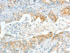 The image on the left is immunohistochemistry of paraffin-embedded Human gastric cancer tissue using CSB-PA983797 (APOL2 Antibody) at dilution 1/80, on the right is treated with synthetic peptide. (Original magnification: ×200)