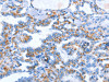 The image on the left is immunohistochemistry of paraffin-embedded Human thyroid cancer tissue using CSB-PA586979 (WNT1 Antibody) at dilution 1/40, on the right is treated with synthetic peptide. (Original magnification: ×200)