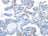 The image on the left is immunohistochemistry of paraffin-embedded Human thyroid cancer tissue using CSB-PA682357 (WNT1 Antibody) at dilution 1/50, on the right is treated with synthetic peptide. (Original magnification: ×200)