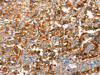 The image on the left is immunohistochemistry of paraffin-embedded Human thyroid cancer tissue using CSB-PA620636 (ARFGEF2 Antibody) at dilution 1/25, on the right is treated with synthetic peptide. (Original magnification: ×200) The image on the left is immunohistochemistry of paraffin-embedded Human thyroid cancer tissue using CSB-PA620636 (ARFGEF2 Antibody) at dilution 1/25, on the right is treated with synthetic peptide. (Original magnification: ×200)