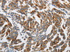 The image on the left is immunohistochemistry of paraffin-embedded Human gastric cancer tissue using CSB-PA438009 (ATG4A Antibody) at dilution 1/45, on the right is treated with synthetic peptide. (Original magnification: ×200)