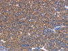 The image on the left is immunohistochemistry of paraffin-embedded Human lymphoma tissue using CSB-PA094270 (NES Antibody) at dilution 1/30, on the right is treated with synthetic peptide. (Original magnification: ×200)