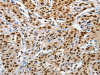 The image on the left is immunohistochemistry of paraffin-embedded Human lung cancer tissue using CSB-PA120136 (PIWIL3 Antibody) at dilution 1/20, on the right is treated with synthetic peptide. (Original magnification: ×200)