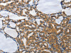 The image on the left is immunohistochemistry of paraffin-embedded Human thyroid cancer tissue using CSB-PA272603 (PIAS2 Antibody) at dilution 1/70, on the right is treated with synthetic peptide. (Original magnification: ×200)