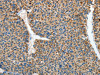 The image on the left is immunohistochemistry of paraffin-embedded Human liver cancer tissue using CSB-PA554520 (RCAN1 Antibody) at dilution 1/45, on the right is treated with synthetic peptide. (Original magnification: ×200)