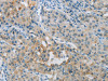 The image on the left is immunohistochemistry of paraffin-embedded Human lung cancer tissue using CSB-PA105506 (PRKCA Antibody) at dilution 1/30, on the right is treated with synthetic peptide. (Original magnification: ×200)